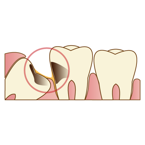 埋伏歯（親知らず）