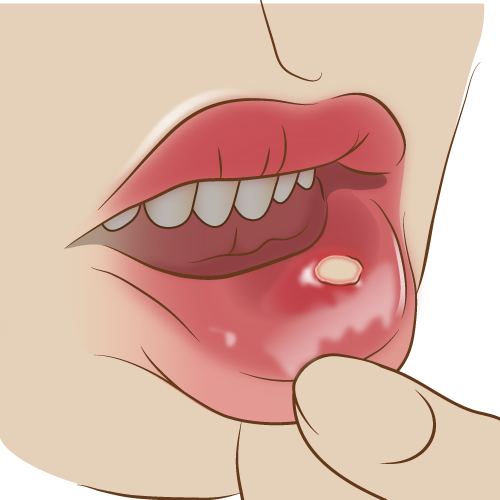口腔粘膜疾患（口内炎）