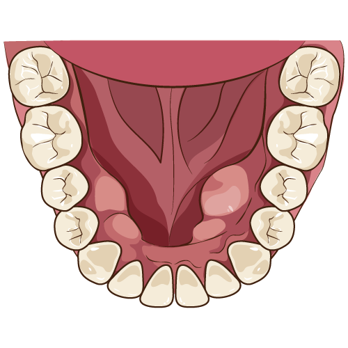 良性腫瘍